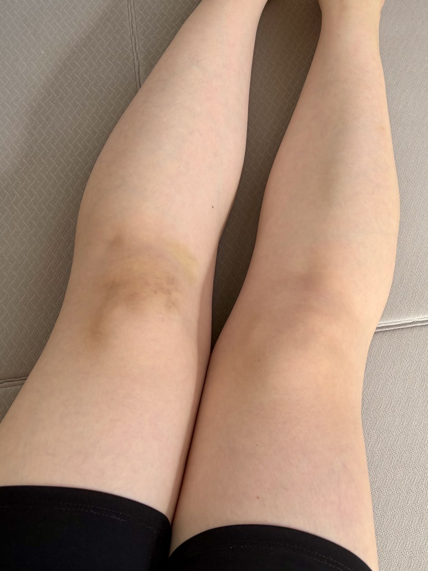 「打撲による内出血で青あざになった膝」打撲・内出血を直接表現。（参考イメージ）